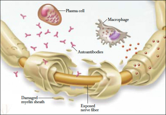 Chronic Immune Demyelinating Polyneuropathy, CIDP