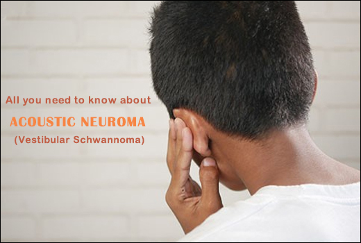 Acoustic Neuroma