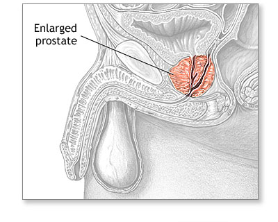 enlarged prostate gland
